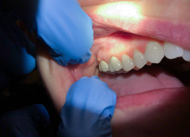 Best Emergency Care for Gum Disease in Rockvale, TN
